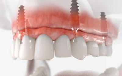 All-On-X Recovery Process: What You Can Expect