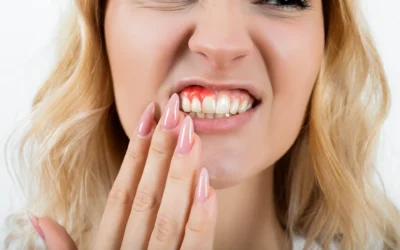 What Causes Gum Disease?