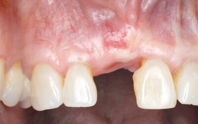 Surgical Solutions Forsoft-tissue Deficienciesin Esthetic Zone: