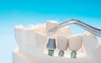 A Step-by-Step Guide to Dental Implants