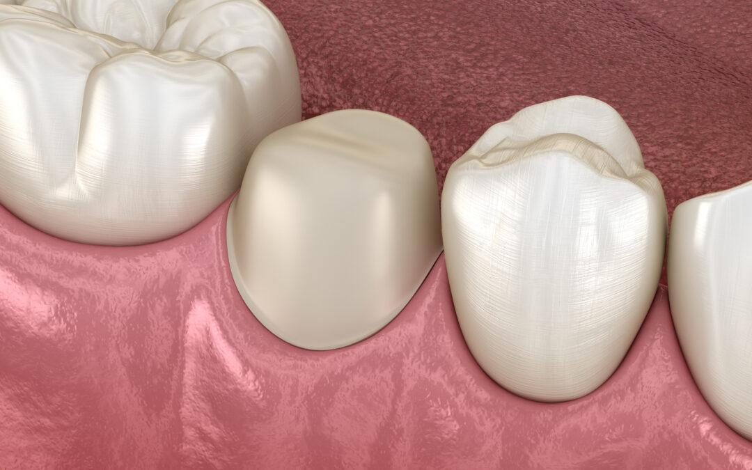Do I Really Need Crown Lengthening Before My New Crown?