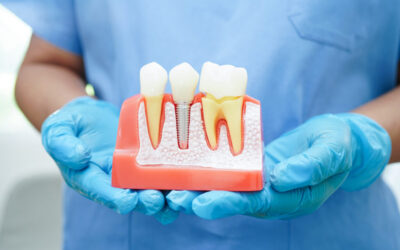 How Dental Implants Help Prevent Jawbone Loss—and Why It Matters