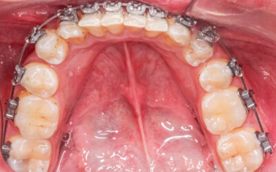 Why a Frenectomy Could Be the Key to Better Oral Health