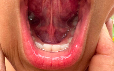 Tori Removal: A Simple Procedure That Can Make a Big Difference