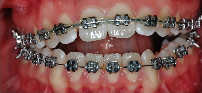 Surgically Facilitated Orthodontics