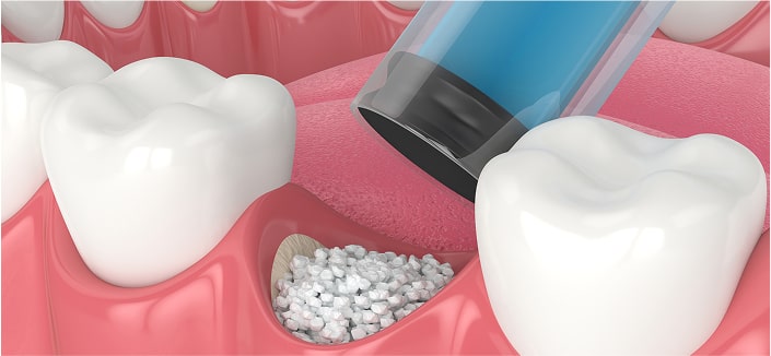 Bone and Sinus Grafting