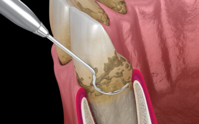 Scaling and Root Planing: The First Step in Fighting Gum Disease