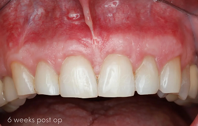 Periodontal Surgery Post Op