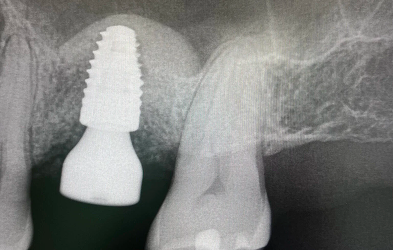 Sinus Lift Surgery Post Op