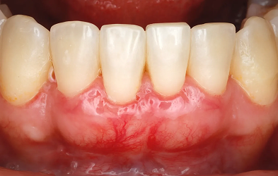 Soft Tissue Surgery Post op