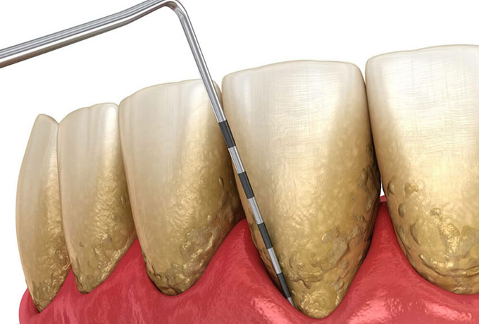 How Osseous Surgery Works