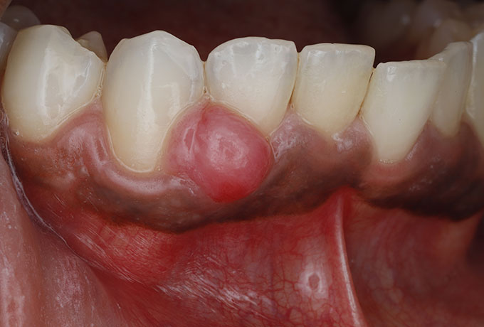 What a Soft Tissue Biopsy Involves