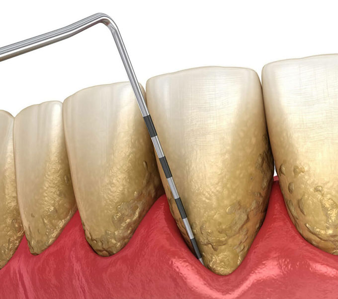 Do You Recognize These Signs