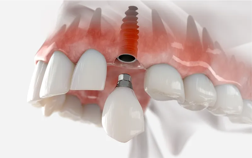 Advanced Options for Every Smile