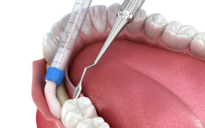 The Role of Bone Grafting in Preserving Your Jaw After Tooth Loss