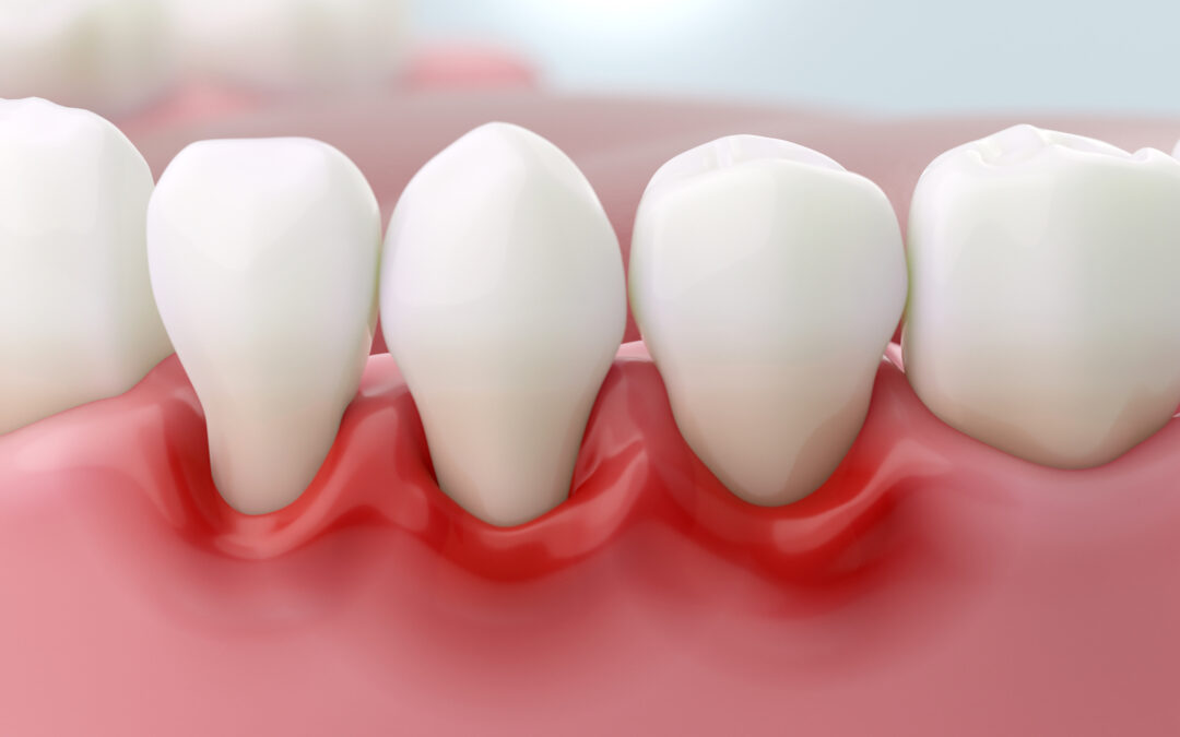 Why Early Gum Disease Treatment Is Key to Long-Term Implant Success