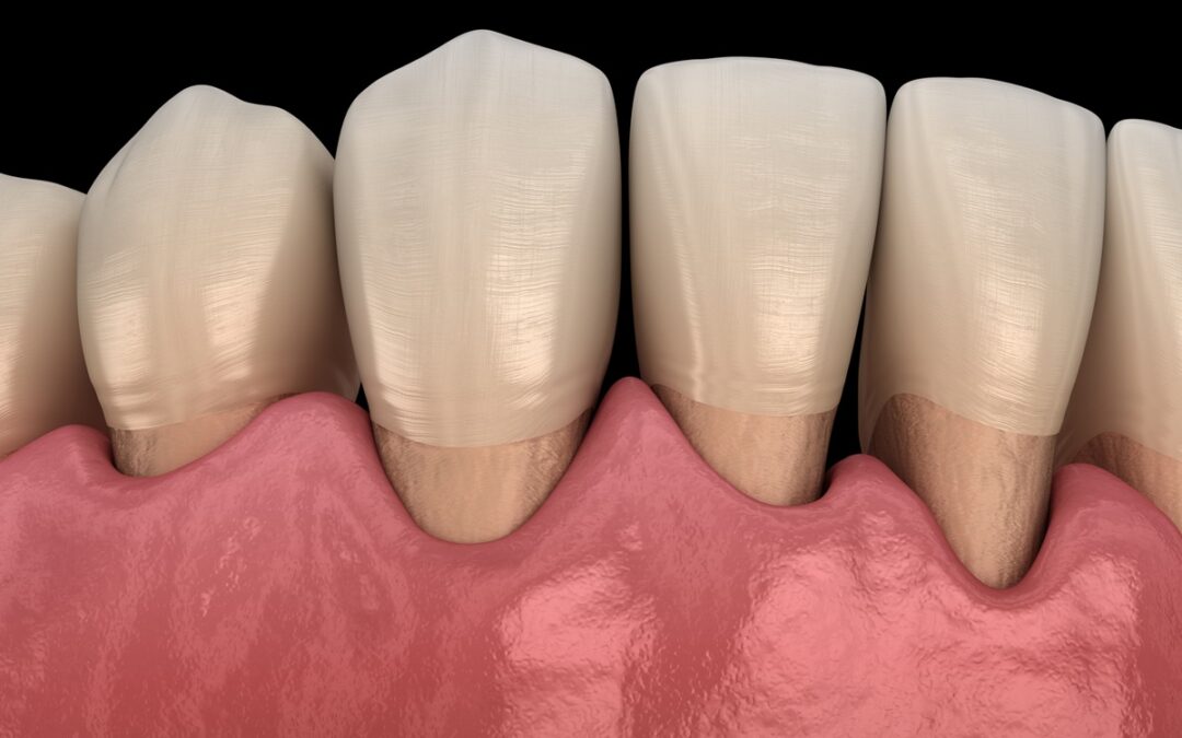 How Do I Know If My Gum Recession Needs Treatment?