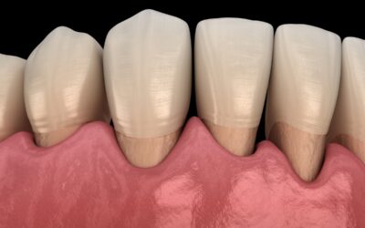 How Do I Know If My Gum Recession Needs Treatment?
