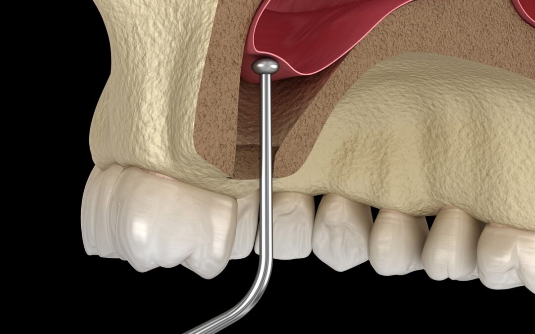 How Long Does It Take to Recover After a Sinus Lift?