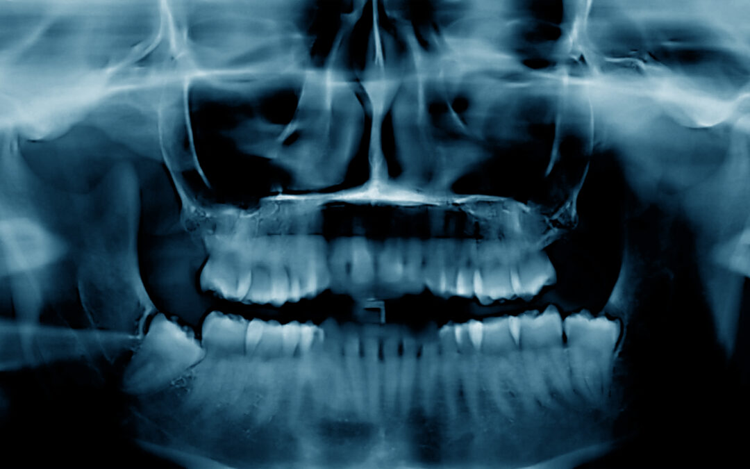 Is Bone Loss Reversible? What Patients Should Know About Modern Regenerative Dentistry