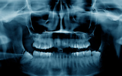Is Bone Loss Reversible? What Patients Should Know About Modern Regenerative Dentistry