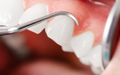 How Periodontal Maintenance Is Different From a Regular Dental Cleaning