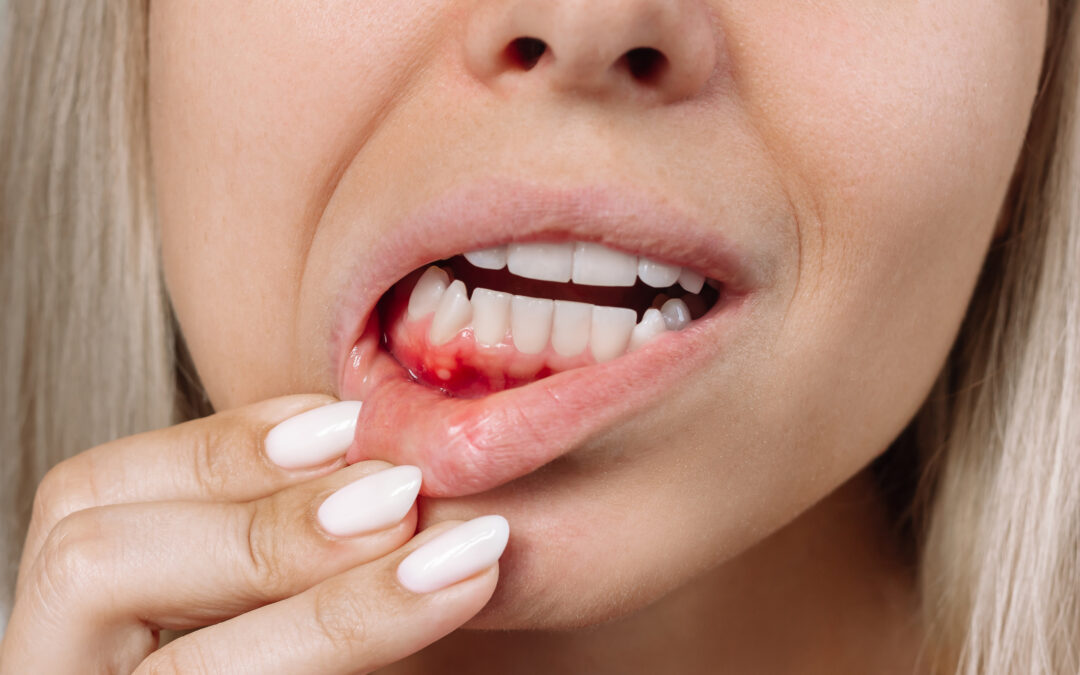 Why Bleeding Gums Are Never “Normal” (Even If They Don’t Hurt)
