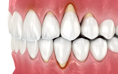 How Do I Know If I Need a Gum Graft or a Less Invasive Treatment?