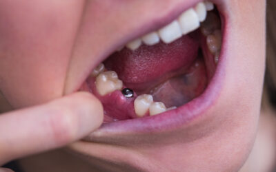 Can Dental Implants Fail Years After Placement?