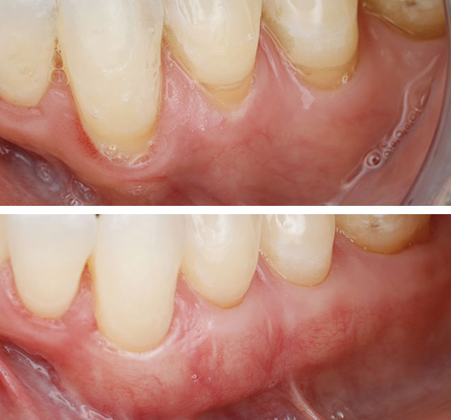 Gum Recession Treatment