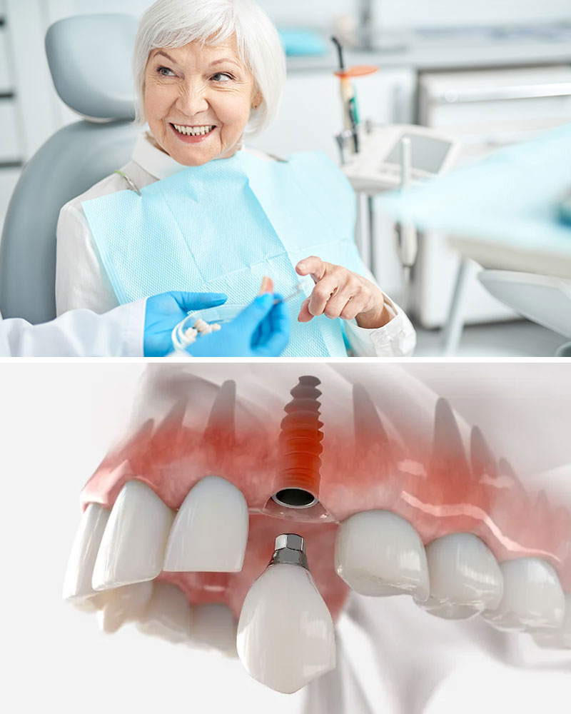Dental Implants