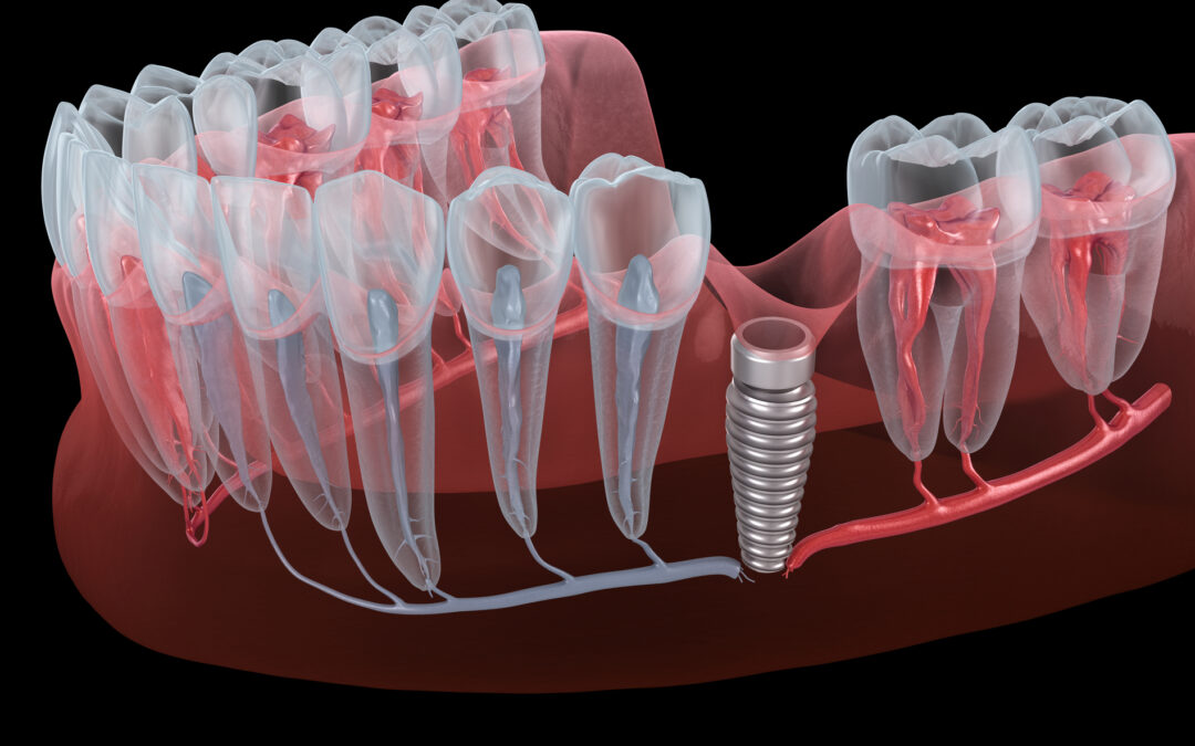 What Happens When a Dental Implant Fails? Causes, Warning Signs, and Treatment Options