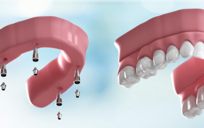 Implant Overdentures vs. Traditional Dentures: Stability, Comfort, and Long-Term Health
