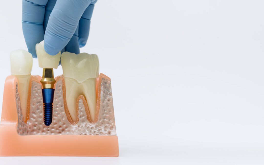 Are Dental Implants Painful?